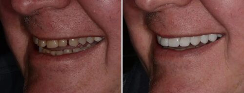 Results after dentistry at AH Smiles