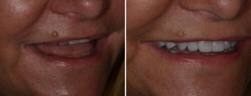 Results after dentistry at AH Smiles