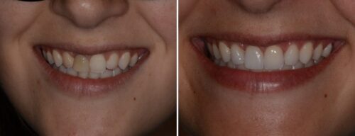 Results after dentistry at AH Smiles