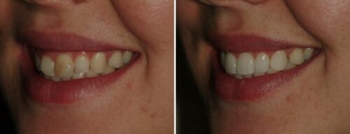 Results after dentistry at AH Smiles