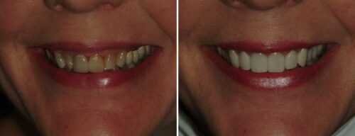 Results after dentistry at AH Smiles