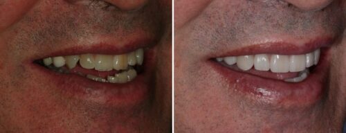 Results after dentistry at AH Smiles