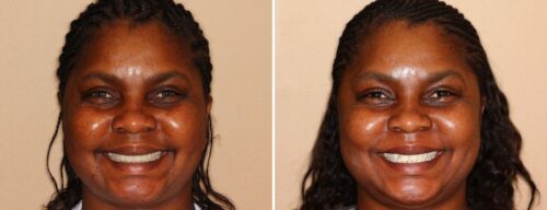 Results after dentistry at AH Smiles