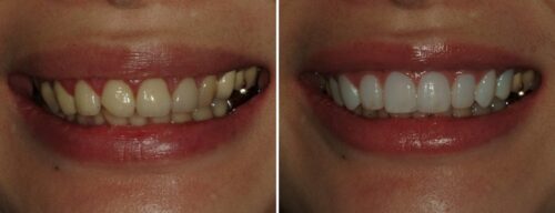 Results after dentistry at AH Smiles