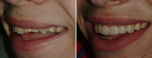 Results after dentistry at AH Smiles