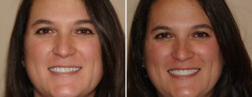 Results after dentistry at AH Smiles