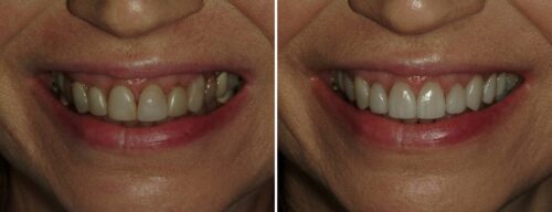 Results after dentistry at AH Smiles