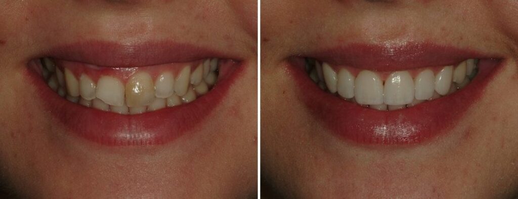 Patient before and after cosmetic dentistry at AH Smiles