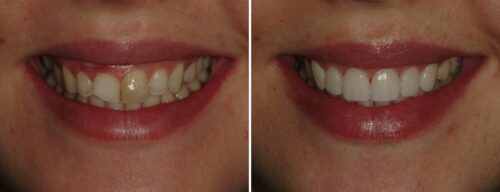 Results after dentistry at AH Smiles