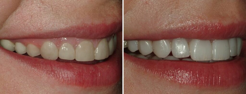 Patient before and after teeth whitening at AH Smiles