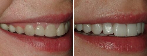 Results after dentistry at AH Smiles