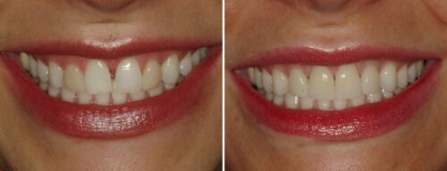 Results after dentistry at AH Smiles