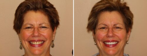 Results after dentistry at AH Smiles