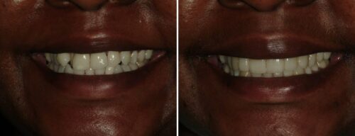 Results after dentistry at AH Smiles