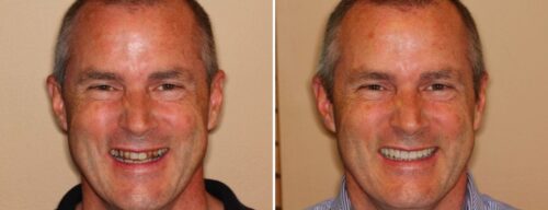 Results after dentistry at AH Smiles