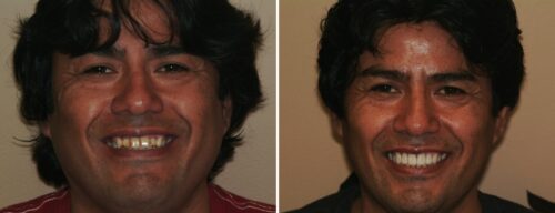 Results after dentistry at AH Smiles