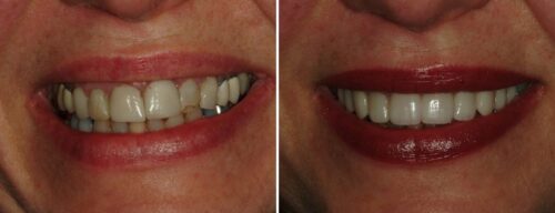 Results after dentistry at AH Smiles