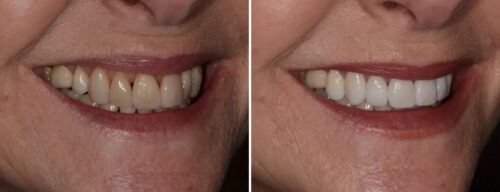 Results after dentistry at AH Smiles