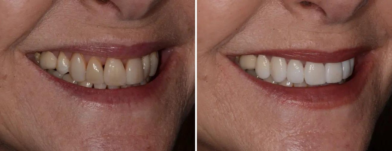 Dental patient before and after getting veneers at AH Smiles