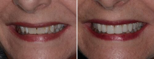 Results after dentistry at AH Smiles