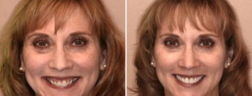 Results after dentistry at AH Smiles