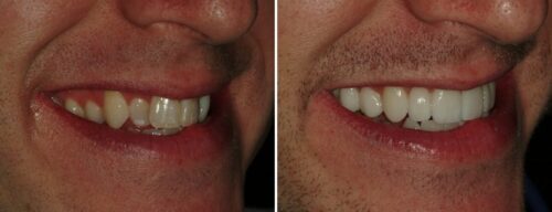 Results after dentistry at AH Smiles