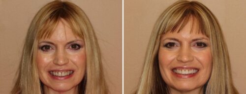 Results after dentistry at AH Smiles