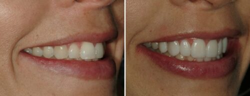 Results after dentistry at AH Smiles