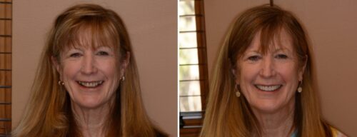 Results after dentistry at AH Smiles