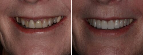 Results after dentistry at AH Smiles