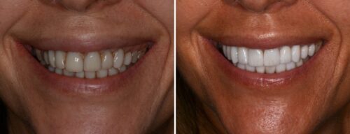 Results after dentistry at AH Smiles