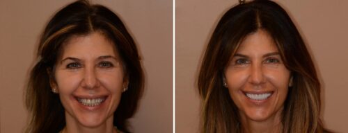 Results after dentistry at AH Smiles