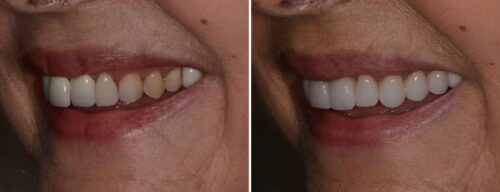 Results after dentistry at AH Smiles