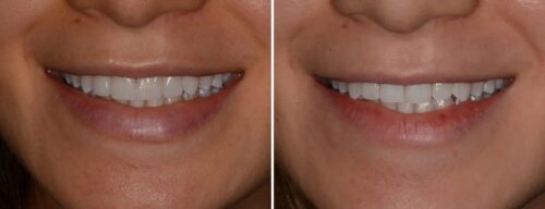 Results after dentistry at AH Smiles