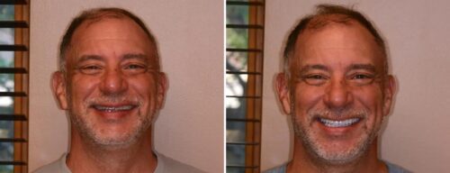 Results after dentistry at AH Smiles