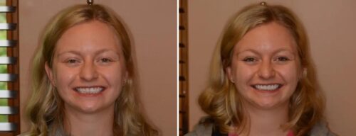 Results after dentistry at AH Smiles