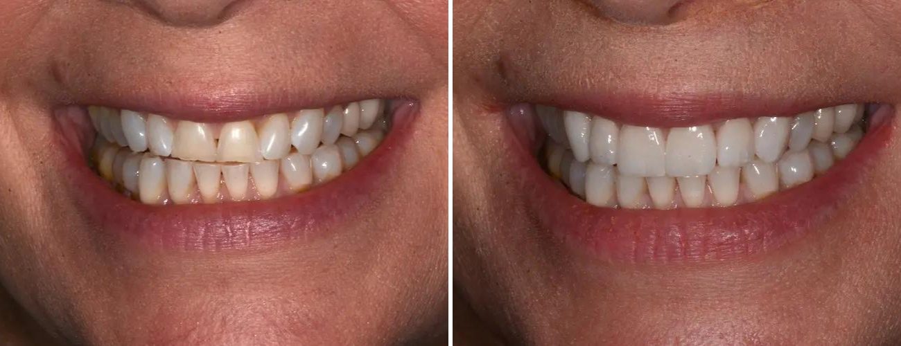 Before and after cosmetic dental treatments at AH Smiles
