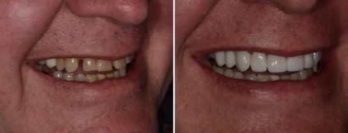 Results after dentistry at AH Smiles