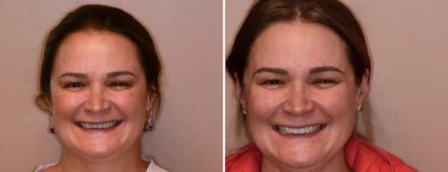 Results after dentistry at AH Smiles