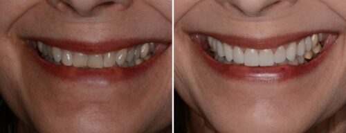 Results after dentistry at AH Smiles