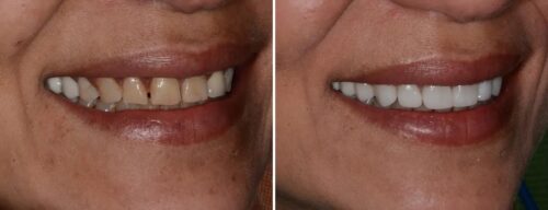 Results after dentistry at AH Smiles