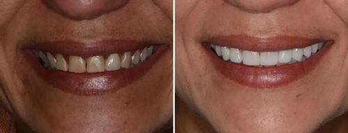 Results after dentistry at AH Smiles