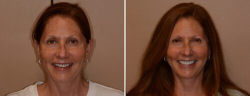 Results after dentistry at AH Smiles