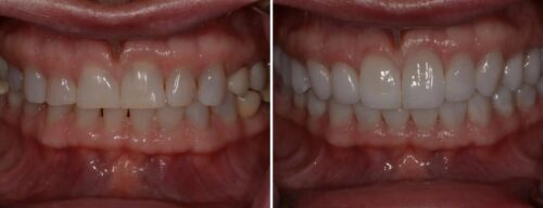 Results after dentistry at AH Smiles