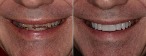 Results after dentistry at AH Smiles