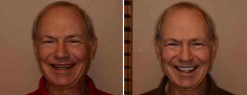 Results after dentistry at AH Smiles