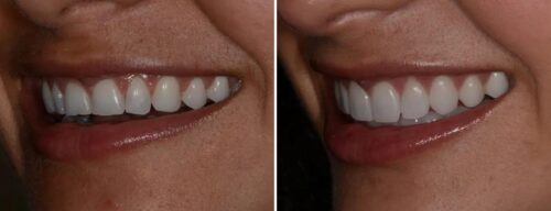 Results after dentistry at AH Smiles