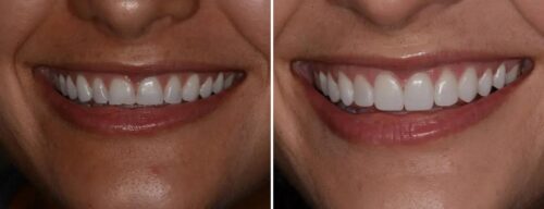 Results after dentistry at AH Smiles