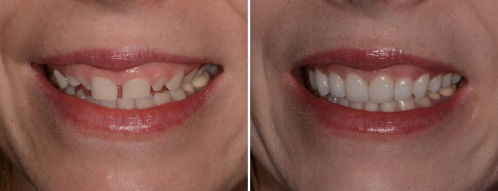 AH Smiles patient before and after full mouth reconstruction