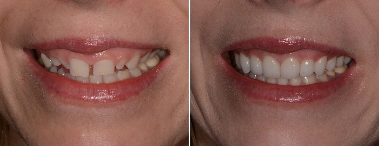 AH Smiles patient before and after full mouth reconstruction
